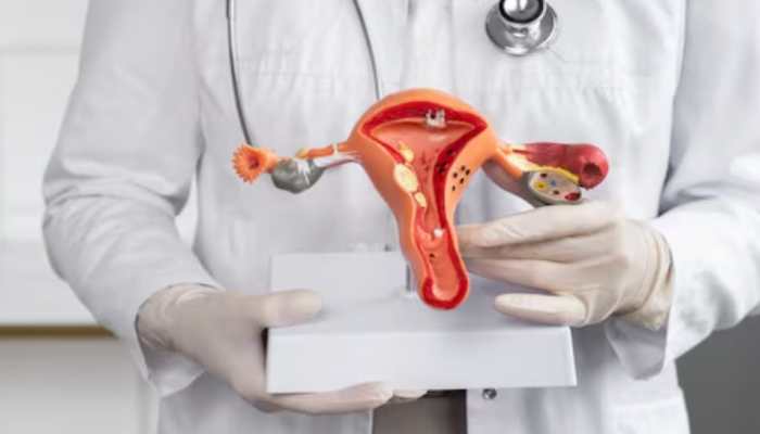 PCOS and Irregular Periods: Experts Bust Common Menstrual Myths