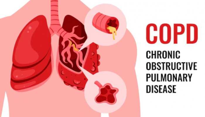 Breathing Easier: How Timely Treatment Can Halt COPD Progression