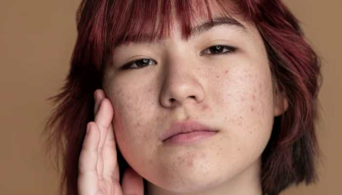 Why Adult Acne Deserves A Real Conversation?