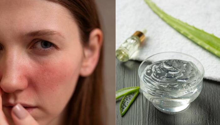 Aloe Vera Side Effects On Skin: Risks, Allergic Reactions, Irritations, And Who Should Avoid Using It