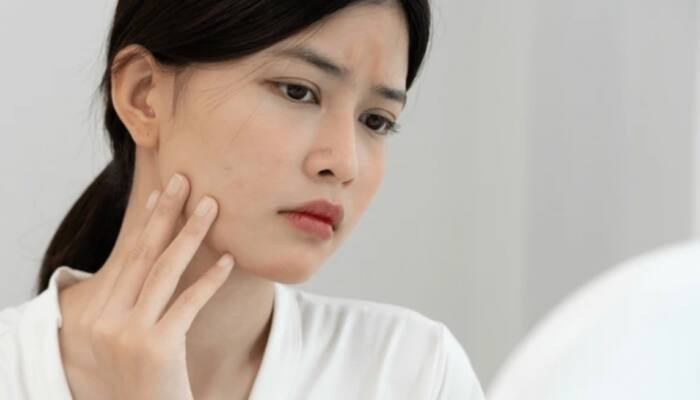 Impact Of Pollution On Skin: Why Are Dullness, Pigmentation, And Acne Increasing?