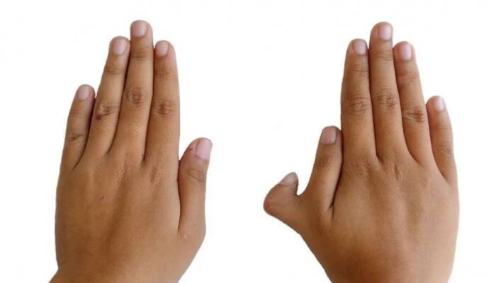 Why Some People Have Six Fingers On Their Hands; Is It Dangerous?