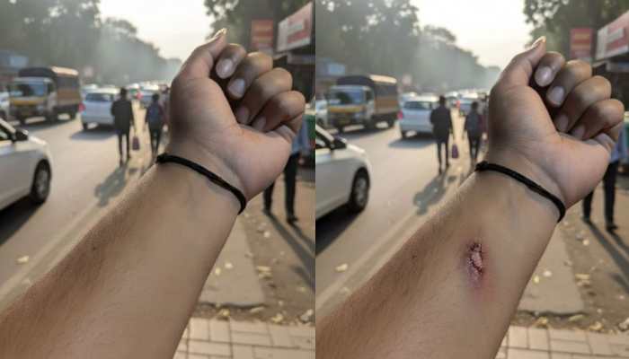 Employee Fakes Injury With Google’s ‘Nano Banana’ AI, Fools Manager; Sparks Internet Uproar