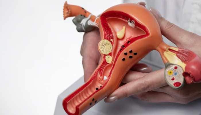 Debunking Myths Linked To Fibroids